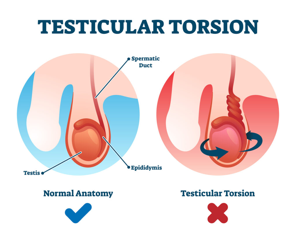 Testicular Torsion